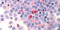 Microscope of human cells with acute myelocytic leukemia. 